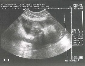 2000-03-22_matt_3nd_ultrasound_31wks.jpg